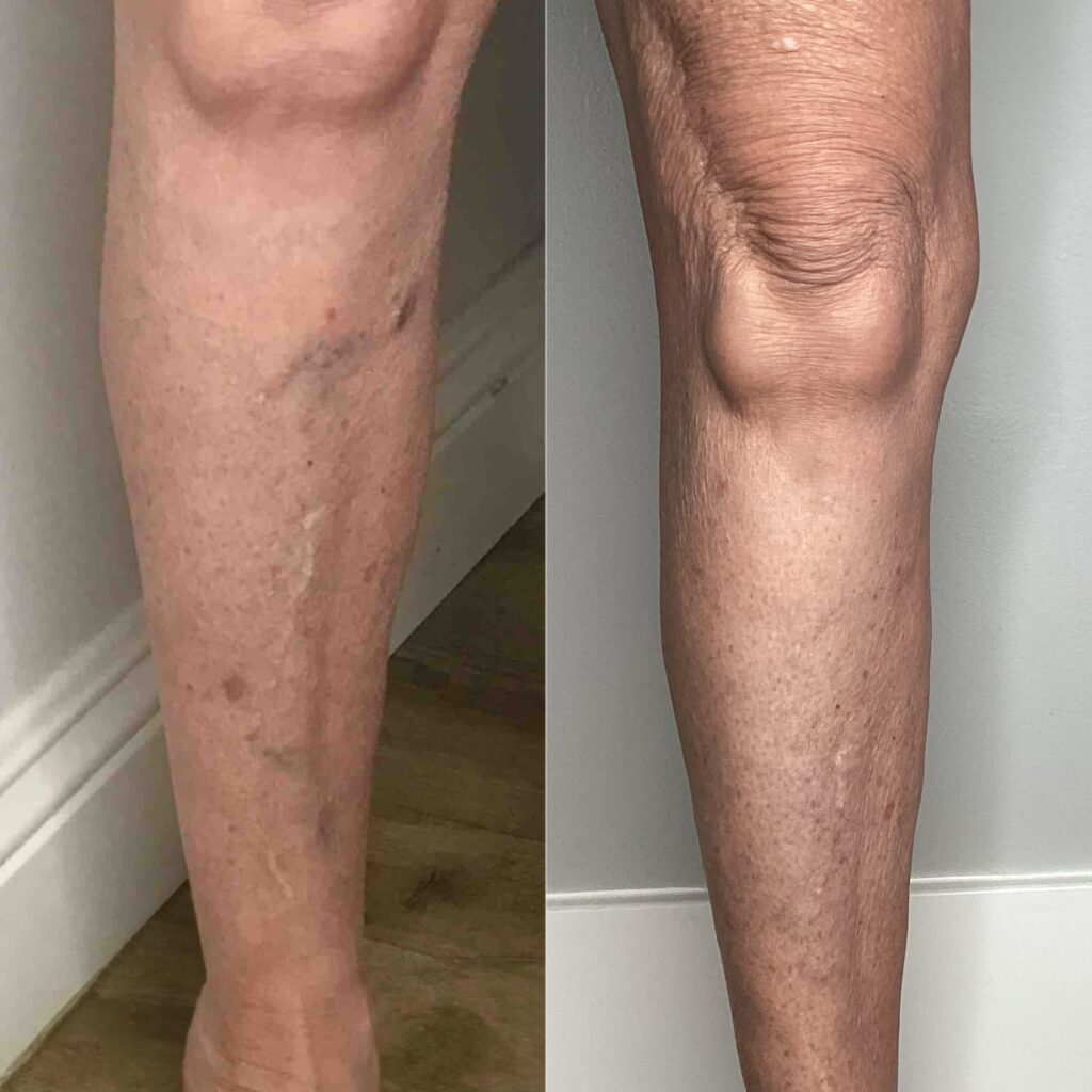 What happens if you ignore vein disease